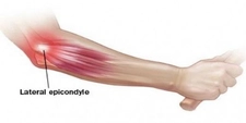 Dirsek İçi Ağrısı Belirtileri ve Tedavisi